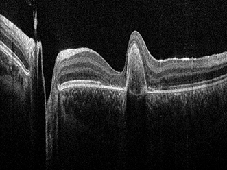 An OCT image of a human retina acquired with the Envisu C2300 SD-OCT system.