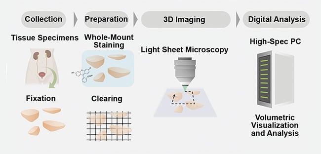 Figure 3. A schematic of a comprehensive 3D pathology workflow. Tissue samples are collected from a patient and fixated. Then the samples undergo a tissue-clearing procedure and are imaged in 3D with digital analysis. Courtesy of A. Glaser/University of Washington Molecular Biophotonics Laboratory.
