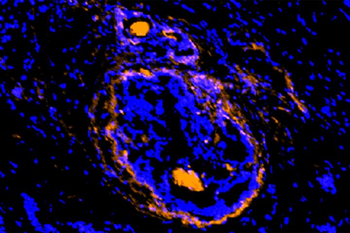 New imaging agent for detecting cancer cells and surrounding cells that protect the cancer, Achilefu lab at Washington University School of Medicine.