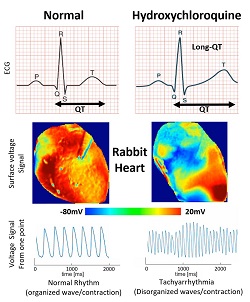 Images show the voltage surface on a rabbit heart with and without HCQ. Without the drug (normal) the electrical activation spreads homogeneously, while with HCQ, waves propagate unevenly, generating complex spatiotemporal patters and arrhythmias. Courtesy of Georgia Tech School of Physics.