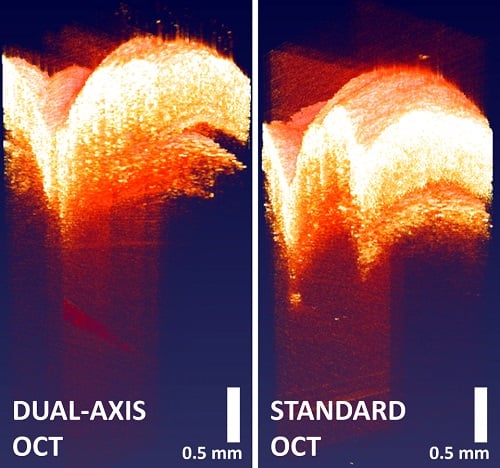 A newly developed “dual-axis” approach to OCT allows researchers to look deeper beneath biological tissue. Here, a needle point more than one millimeter beneath a mouse’s skin can be seen toward the bottom of the dual-axis image (left) but not in the standard image (right). The signal of the needle in both has been adjusted for better visualization of the needle. Courtesy of Evan Jelly.