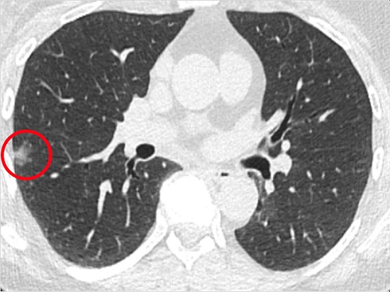 Scan of a patient in the Penn Medicine-led study with a lung nodule, circled in red. Courtesy of Penn Medicine. 