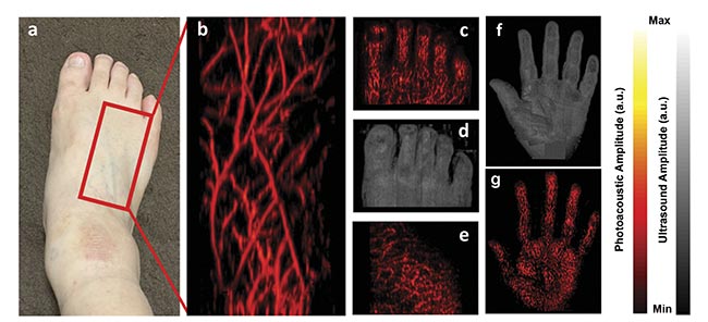 Figure 3. The location on a human foot where the imaging was performed (a). A 3D maximum intensity projection (MIP) photoacoustic image of the area marked in (a), visualizing fine microvasculature network (resolution: ~200 µm) (b). A 3D MIP photoacoustic image of the foot’s toes (c). A 3D MIP ultrasound image of the toes (d). A 3D MIP photoacoustic image of the plantar area of the foot (e). A 3D structural ultrasound MIP image of the palm of a human hand, generated by combining 10 line-by-line scan ultrasound MIP images (f). A 3D vascular photoacoustic MIP image of the palm generated by combining 10 LED-based photoacoustic MIP images (g). Courtesy of CYBERDYNE Inc.