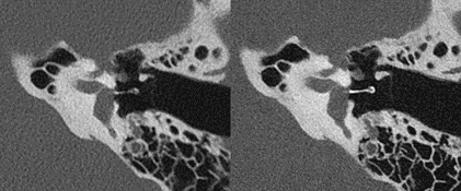Conventional CT (left) image of an inner ear prosthesis compared to PCD-CT system. The structures of the inner ear are composed of tiny bones that are difficult to visualize. Clinicians can get much clearer inner ear images with PCD-CT, which could help with cochlear implants for children. Courtesy of Cynthia McCollough, Mayo Clinic.