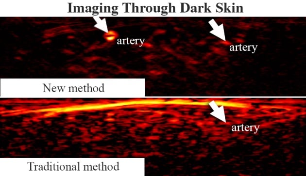 A comparison of two PA images of the same dark-skinned study participant shows that images made with conventional methods are cluttered, while the new imaging technique makes arteries easier to spot. Courtesy of Johns Hopkins University/University of São Paulo, Brazil.