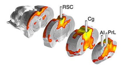 Researchers at the UNC School of Medicine combined fiber photometry with fMRI to examine the dynamic activity of brain regions related to the brain’s DMN (shown via graphical representation). Experimental results showed that activation of the brain’s anterior insular cortex is associated with the suppression of the DMN. Courtesy of the Shih Lab/UNC School of Medicine.