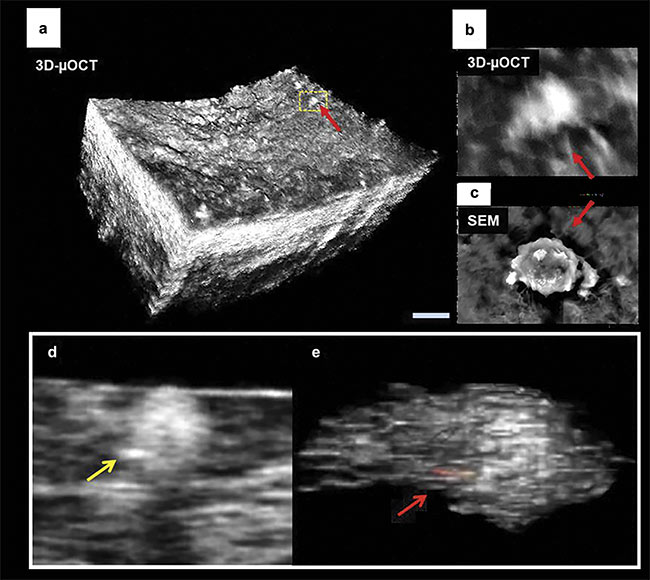 Figure 3. 3D micro-OCT of endothelial cell morphology of a lipid-rich human coronary plaque with adhered leukocytes (red arrows) (a, b). Co-registered scanning electron microscopy (SEM) image showing an individual leukocyte tethered to the surface (c). A representative image of macrophage cells in a human coronary artery containing highly scattering inclusions within their cytoplasm (e). Scale bars: 100 µm (a); 10 µm (b, c). Images (a) and (c) adapted with permission from Reference 6; images (d) and (e) adapted with permission from Reference 7.