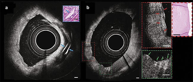 Figure 4. Images from a catheter-based intravascular micro-OCT of a human cadaver coronary ex vivo (a). A circumferential view of micro-OCT showing multiple cholesterol crystals characterized by strong optical reflections from their top and bottom surfaces, and a cross section of an artery exhibiting probable smooth muscle cells (red arrows) (b, inset) and macrophages undergoing diapedesis (green arrows) (inset). Scale bars: 100 µm. Adapted with permission from Reference 8.