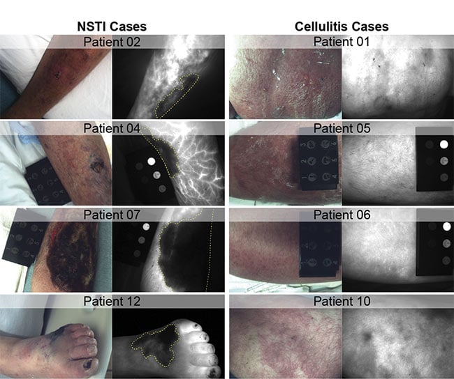 Figure 2. Representative room light and 800-nm channel indocyanine green (ICG) fluorescence images from the Dartmouth pilot study demonstrating confirmed necrotizing soft-tissue infections (NSTIs) (left column), and cellulitis infections (right column). Prominent signal voids are present in all NSTI cases (yellow dashed lines), indicative of NSTI-caused tissue breakdown and vascular thrombosis. Cellulitis cases exhibit marked ICG hyperintensity in affected tissues without signs of thrombosis. Courtesy of Dartmouth Health.