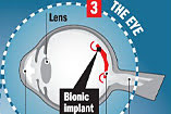 Bionic Eye