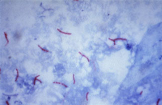 tuberculosis.jpg