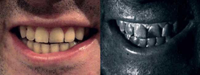 A left incisor repaired with dental resin. Left: color, right: near-UV.