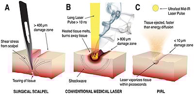 Hofte opskrift Stræde Ultrafast Mid-IR Laser Scalpel Leaves Tiny Scars | Research & Technology | Oct 2010 | Photonics.com Hofte opskrift Stræde Ultrafast Mid-IR Laser Scalpel Leaves Tiny Scars | Research & Technology | Oct 2010 | Photonics.com