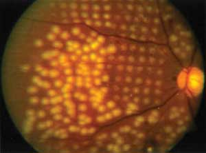 Photocoagulation: Healing Through Laser Damage