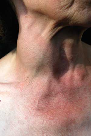 Transoral Laser Microsurgery Fights Laryngeal Cancer