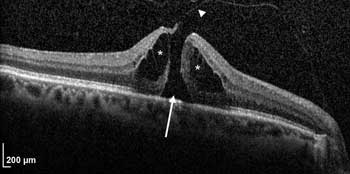 OCT Moves from Clinic to OR to . . . Home?