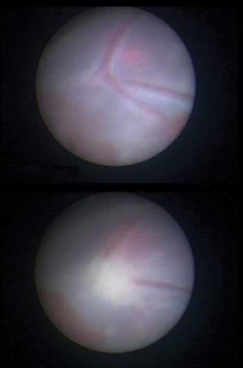 Photocoagulation Refinements Are Decimating Birthmarks 
(but Improving Birth Outcomes)