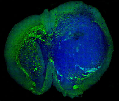 This image of a human glioblastoma brain tumor in the brain of a mouse was made with stimulated Raman scattering, or SRS, microscopy.