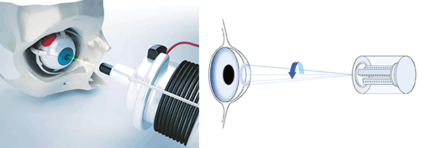 Precise positioning technology is used to steer lasers for eye surgery.