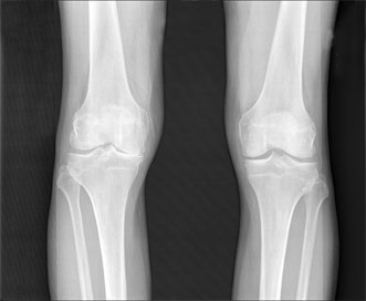 An x-ray image of osteoarthritic knees.