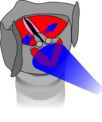 Stimulation of the larynx