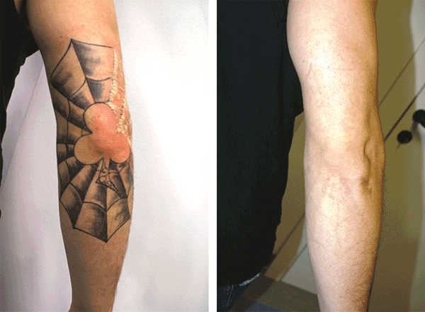 Candela Medical UK  Ireland on Twitter Great tattooremoval work once  again from the Team at InvisibleInk Tattoo Removers that highlights the  efficacy of PicoWay treatments on darker skin Learn more about