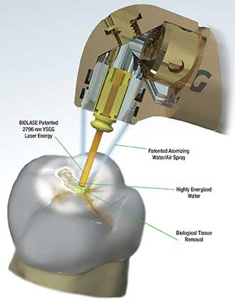 How a laser is used in dental treatment. 