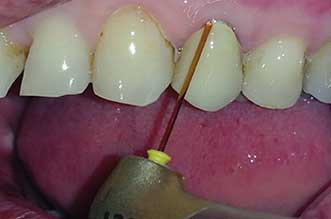 Lasers can eliminate the use of needle and drill for tooth and gum surgery.