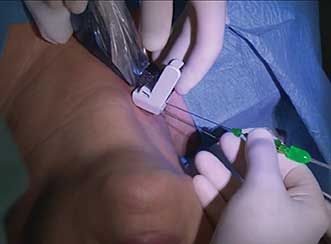 With ultrasound guiding the placement of fiber optic bearing needles, surgeons use a laser to destroy thyroid nodules.