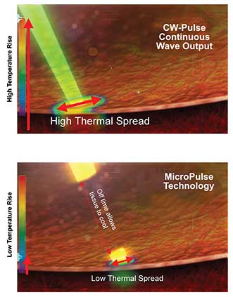 The best results occur when wavelength, pulse width, power and other parameters of surgical lasers are optimized. 