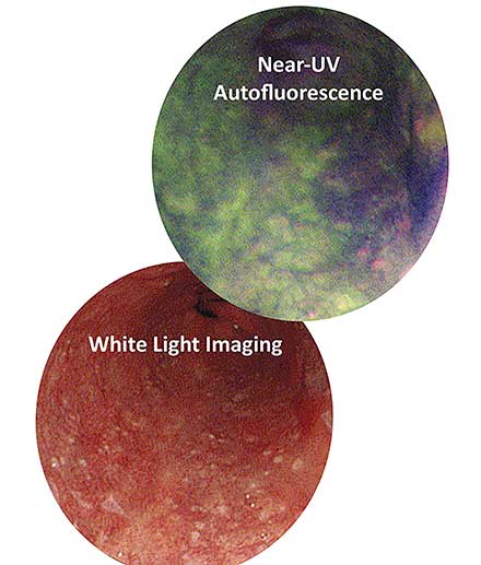 The area in dark purple reveals a suspicious lesion under autofluorescence, while it eludes detection under white light.