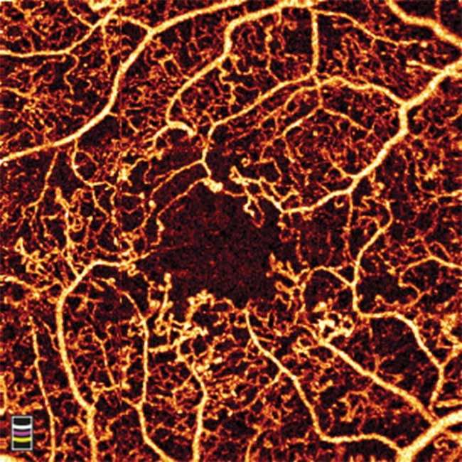 Areas of capillary dropout and the microaneurysms associated with diabetic retinopathy are visualized in this Angiovue image of macular region.