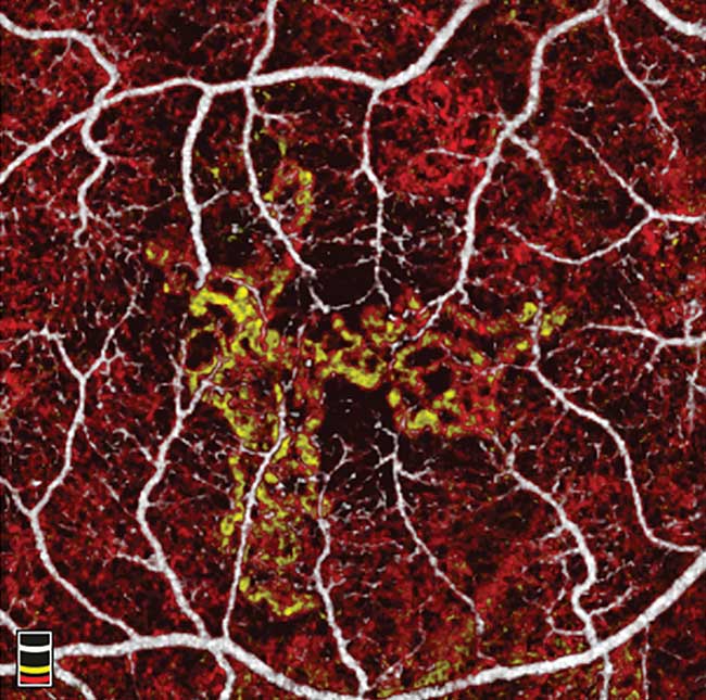 The abnormal vasculature arising from a choroidal net in the outer retina is clearly visualized in yellow, distinct from the red colorization of the choroidal layer.
