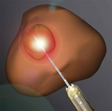 Heat from Laser Ablation May Treat Cancer Safely, Effectively