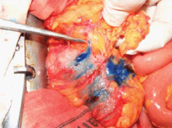 Methylene blue dye injected around a colorectal tumor to map lymph nodes. 