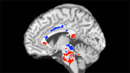 Imaging Technique Helps Predict Long-Term Effects of Concussion