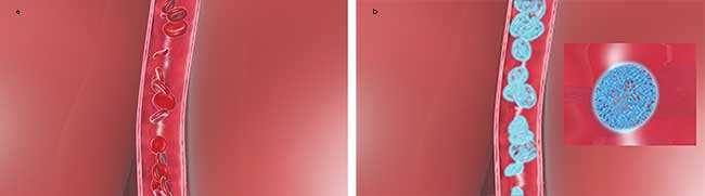 Noninvasix’s probe emits NIR light into the superior sagittal sinus (SSS) (a), where it is absorbed by hemoglobin, which thermally expands as it is oxygenated (b).