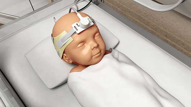 Noninvasix’s monitoring system involves a head strap with an optoacoustic probe consisting of a compact nanosecond Nd:YAG laser that sits above the superior sagittal sinus (SSS), the largest dural venous sinus that runs down the middle of the brain.