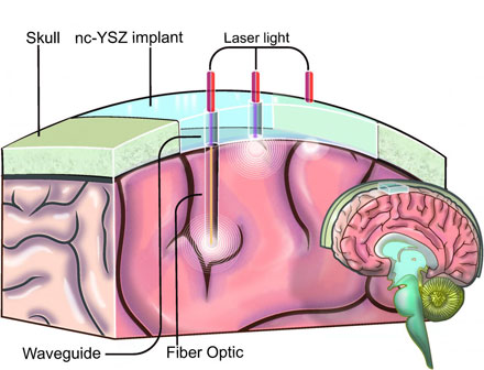 This is an illustration showing how the 'Window to the Brain' transparent skull implant created by UC Riverside researchers would work. 