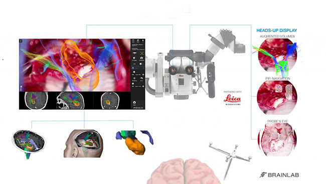 CaptiView overlays critical virtual reality imaging directly onto the brain when viewed through the eyepiece, known as the ocular, during surgery.