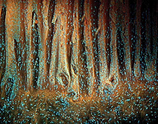  Abundant growth of skin epithelium in a plantar wart. Orange elastin fibers are visible below the epithelial layer.