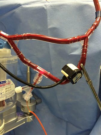 The blood-monitoring device taps directly into the heart-lung machine used to circulate blood during a patient's surgery. 