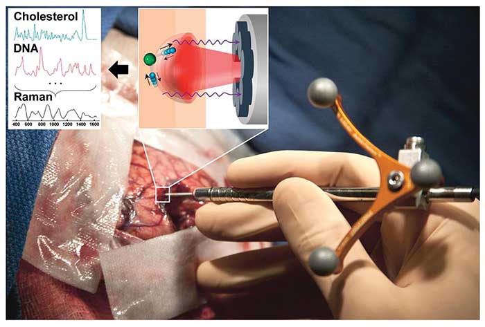 This handheld Raman device is used to distinguish cancerous tissue from normal brain tissue.