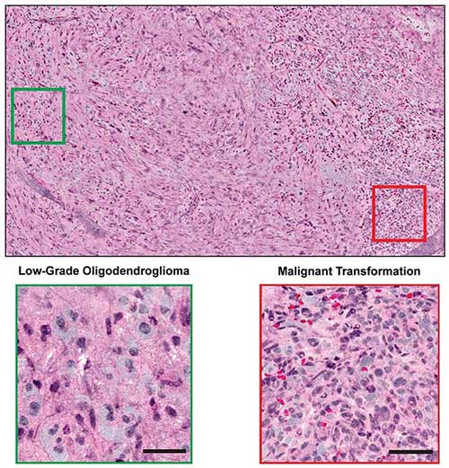 Combined with supervised machine learning, stimulated Raman histology by intraoperative SRS microscope effectively differentiated among diagnostic classes of brain tumors with 90 percent accuracy in neurosurgical patients.