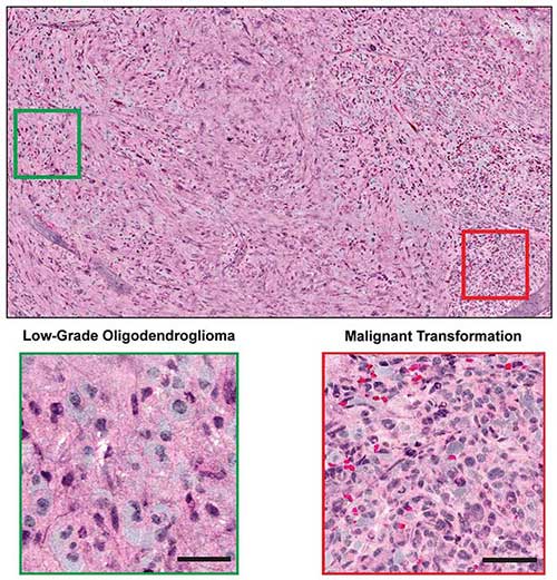 Combined with supervised machine learning, stimulated Raman histology by intraoperative SRS microscope effectively differentiated among diagnostic classes of brain tumors with 90 percent accuracy in neurosurgical patients. 