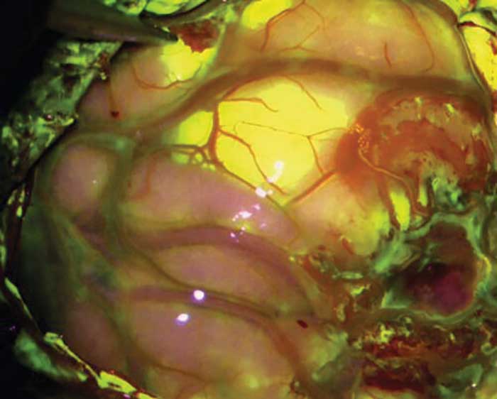 YELLOW 560, another Zeiss product that is approved for research use in the U.S., is the first fluorescence module highlighting the fluorescence-stained structures while viewing nonstained tissue in its natural color. 