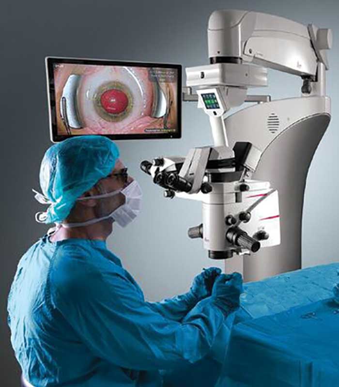 This ophthalmic cataract surgery makes use of the Prove 8 ophthalmic microscope and IOL guidance software from Leica.