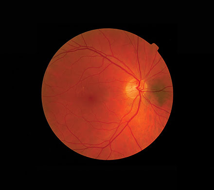 Optical coherence tomography (OCT) is most often used in ophthalmology for diagnosis and monitoring of retinal disease.
