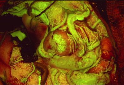 View of an Arteriovenous Malformation (AVM) viewed with FL560 fluorescence. 