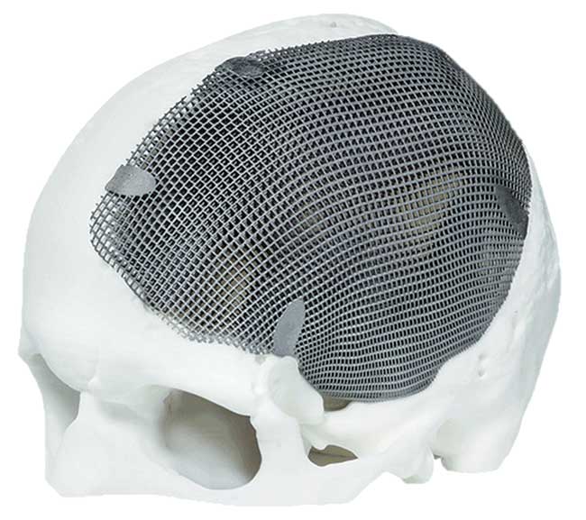 Laser Sintering Moves Into the Medical Market